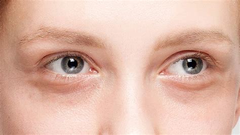 3 Things You Do Everyday That Cause Under Eye Circles Shefinds