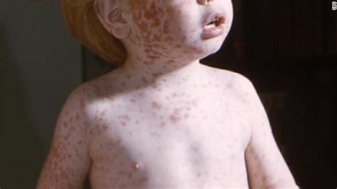 Us Measles Cases In 2013 May Be Most In 17 Years