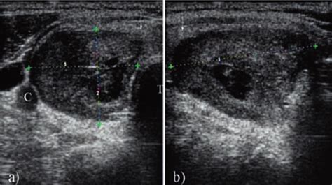 Ultrasound Aspect Of The Intrathyroid Parathyroid Ad Enoma In A