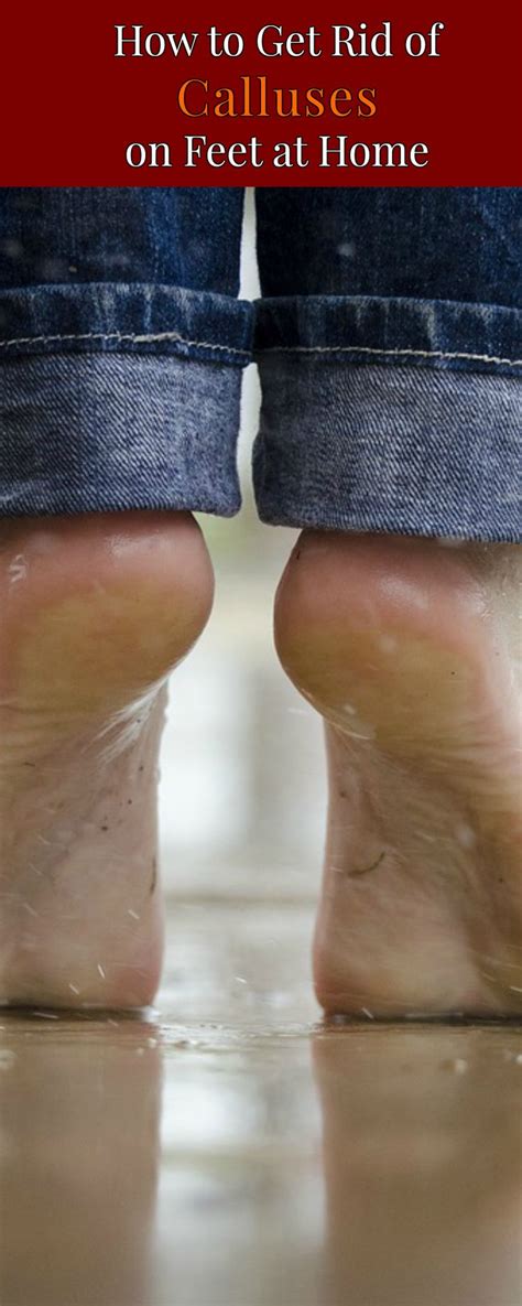 Wash the feet after this, dry and apply a moisturizer. How to Get Rid of Calluses on Feet at Home in 2020 | Foot ...