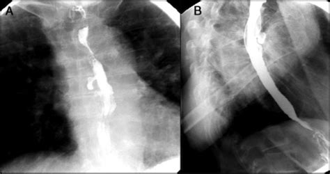 Esophagus Diverticula The Operative Review Of Surgery