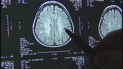 Study indicates COVID-19 causes brain damage, even in mild cases | CTV 