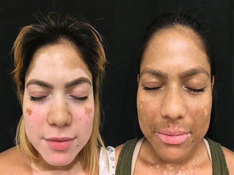 Vitiligo Treatment