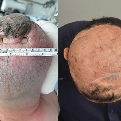 Preoperative Scalp Wound And Postoperative Photo Showing Complete Wound