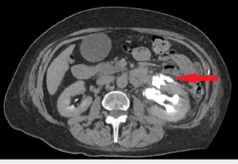 Axial Contrast Ct Scan Showing Extravasation Of The Contrast At The