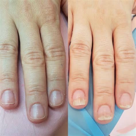 Onycholiza płytek paznokciowych przyczyny objawy leczenie