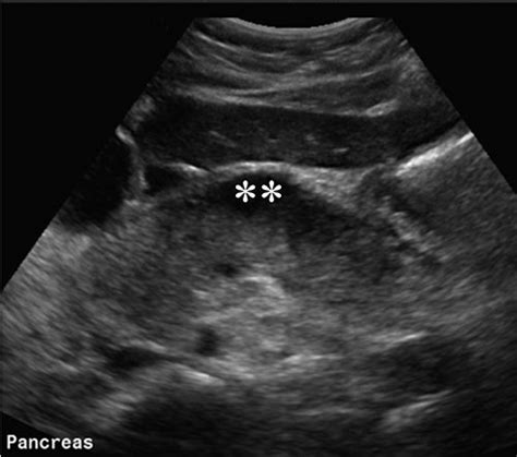 Ultrasound Assessment Of Right Upper Quadrant Abdominal