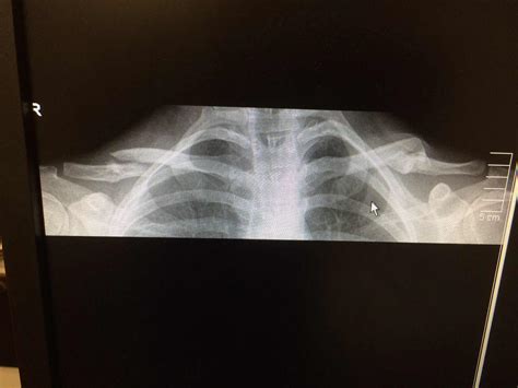 Broken Collar Bone Recovery Time - Page 43 - Pinkbike Forum