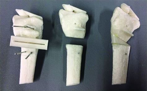 3d Printing For Corrective Osteotomy Of Malunited Distal Radius