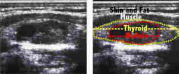 Throat cancers grow in the organs that help about half of these cancers happen in the throat itself, the tube that starts behind your nose and ends in your neck. Thyroid Nodule Ultrasound: What is it, what does it tell ...