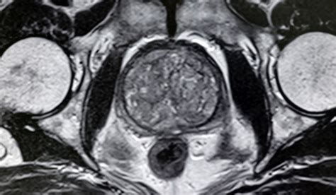Holep For Benign Prostatic Hyperplasia Vanderbilt Discover