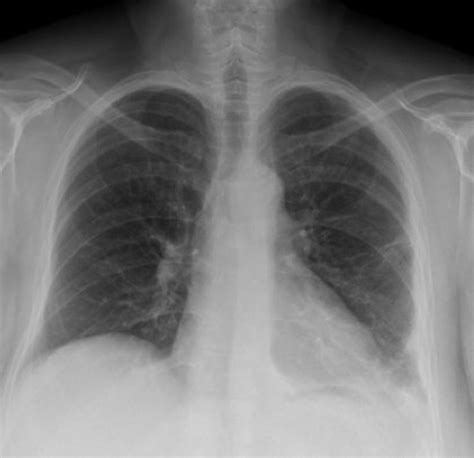 Chest Radiograph Following Thoracotomy Decortication Pleurodesis And