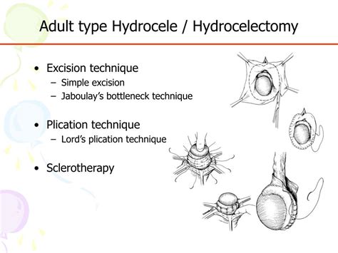 Ppt Surgical Treatment Of Hydrocele And Hernia Powerpoint Presentation