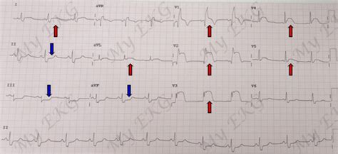 Localizaci N De La Arteria Ocluida En Un Infarto Con El Ekg