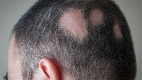 Alopecia Areata Spot Baldness The Lifestyle Clinic