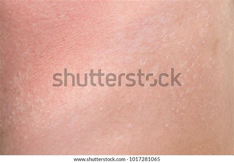 Burnt Skin Sunburn Great Extent Sun Stock Photo Edit Now 1017281065