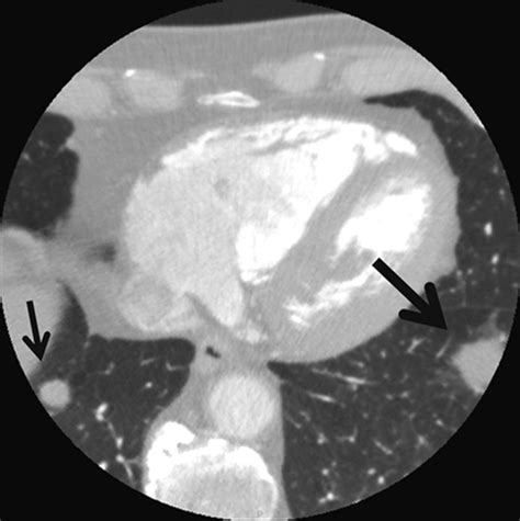 Coronary Computed Tomographic Angiography And Incidental Pulmonary