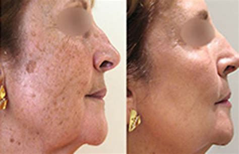 Effective Techniques For Removing Aging Spots Removemania