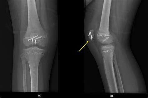 Cureus Patellar Sleeve Fracture In An Eight Year Old Girl