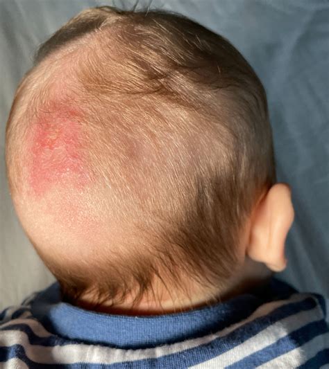 Fungal Infection In Babies Risks Treatment And Remedies Momjunction