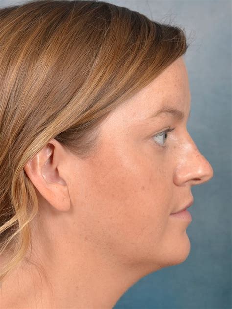 Patient 141524227 Deep Neck Lift Before And After Photos Starkman