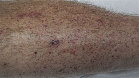 Learn about the symptoms, causes and treatment options in the leukemia condition guide available at u.s. Petechiae: Causes, Treatments, Pictures, and More