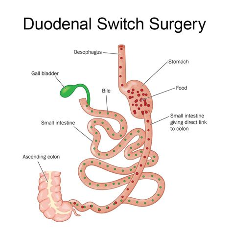 How Long Do You Lose Weight After Duodenal Switch Surgery Plano Tx
