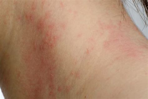 Contact Dermatitis Skin Rash From Allergens Triggered