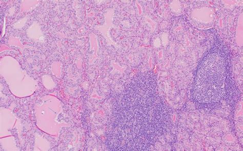 Histology Of Graves Disease My Endo Consult