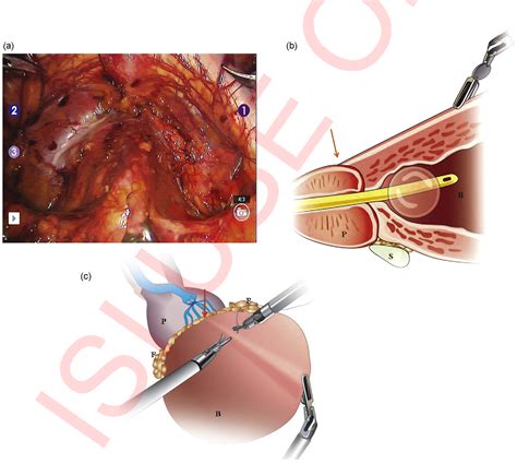 Figure From Anatomic Bladder Neck Preservation During Robotic Assisted Laparoscopic Radical
