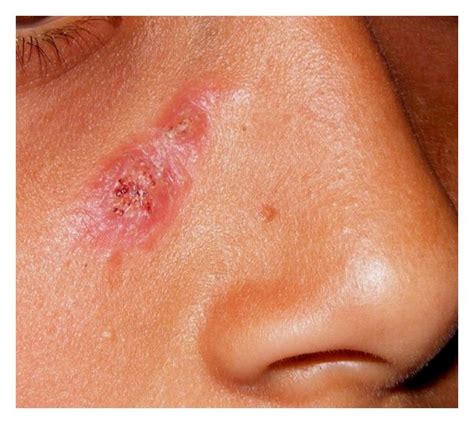 Fixed Cutaneous Sporotrichosis A Crustedverrucous Plaque Develops At