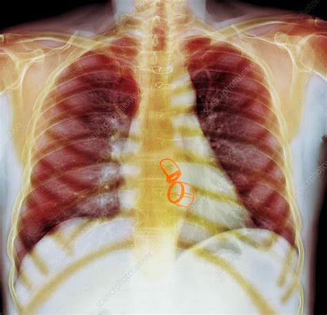Prosthetic Heart Valves X Ray Stock Image F0083450 Science