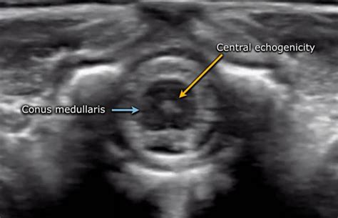 Ultrasound Of The Neonatal Spine 2023