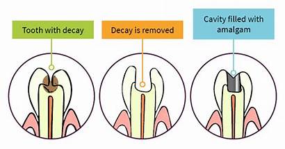 Amalgam Filling Diagram Fillings Dental Teeth
