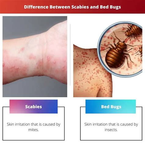 Scabies Vs Bed Bugs Difference And Comparison