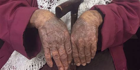 An Unusual Photodermatosis The Bmj