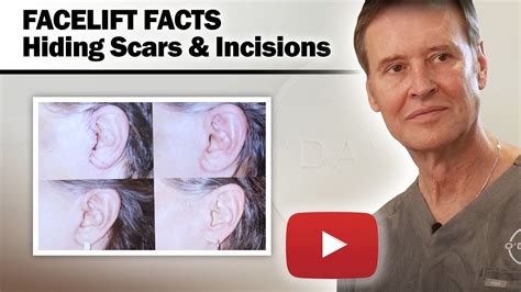Facelift Facts Hiding Scars And Incisions Dr Odaniel Youtube