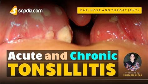 Acute And Chronic Tonsillitis