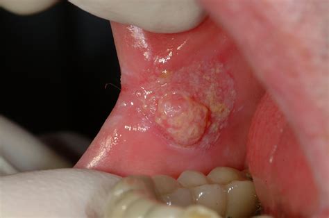 Mouth Cancer Dental Implants
