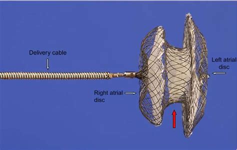 Figure 1 From Device Closure Of Secundum Atrial Septal Defects And The