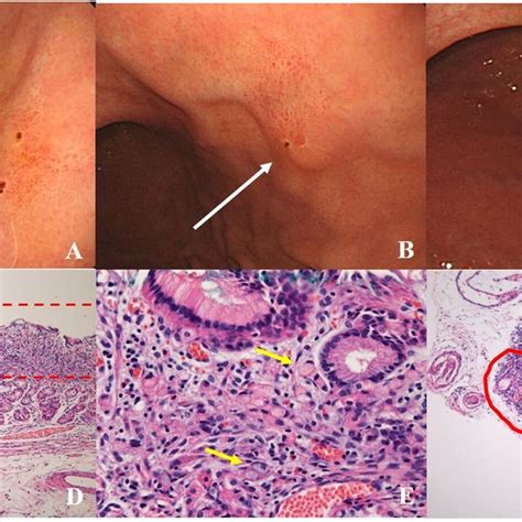 Endoscopic Appearance Of Stages Of Ulcer In Egc A A1 Stage B A2