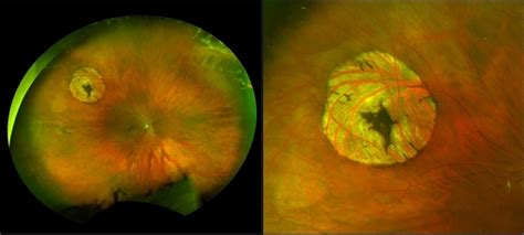 Operculated Hole And Chrpe Retina Image Bank