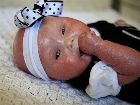 Meet Brenna A Baby With Harlequin Ichthyosis Photo 3 Pictures