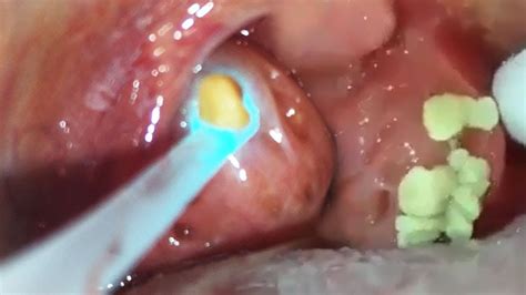 How do tonsil stones develop? Tonsil Stone Popcorn! What are tonsil stones? - YouTube