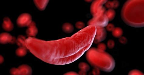 Sickle cell anemia) ist eine erbliche erkrankung der roten blutkörperchen (erythrozyten). Sichelzellanämie: Dosierspritzen mit Hydroxycarbamid ...