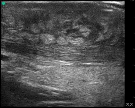 Skin Abscess Ultrasound