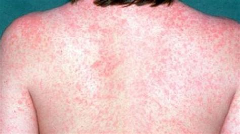 Measles Early Warning Signs People Need To Know Sunshine Coast Daily