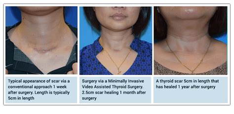 Thyroid Head And Neck Ent Clinic Dr Dennis Chua Clinic