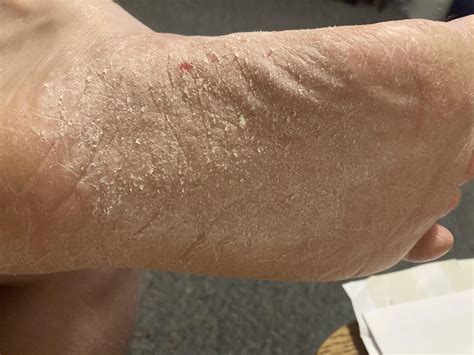 What The Heck Is This Details In Comments Rdermatologyquestions