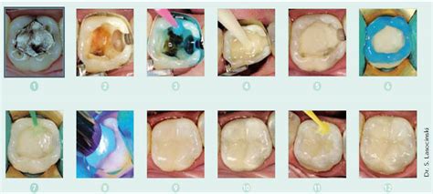 Fillings For The Cavity Filled Teeth Dr Nechupadam Dental Clinic